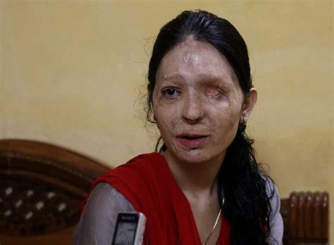 reshma khatun|india acid attack victims.